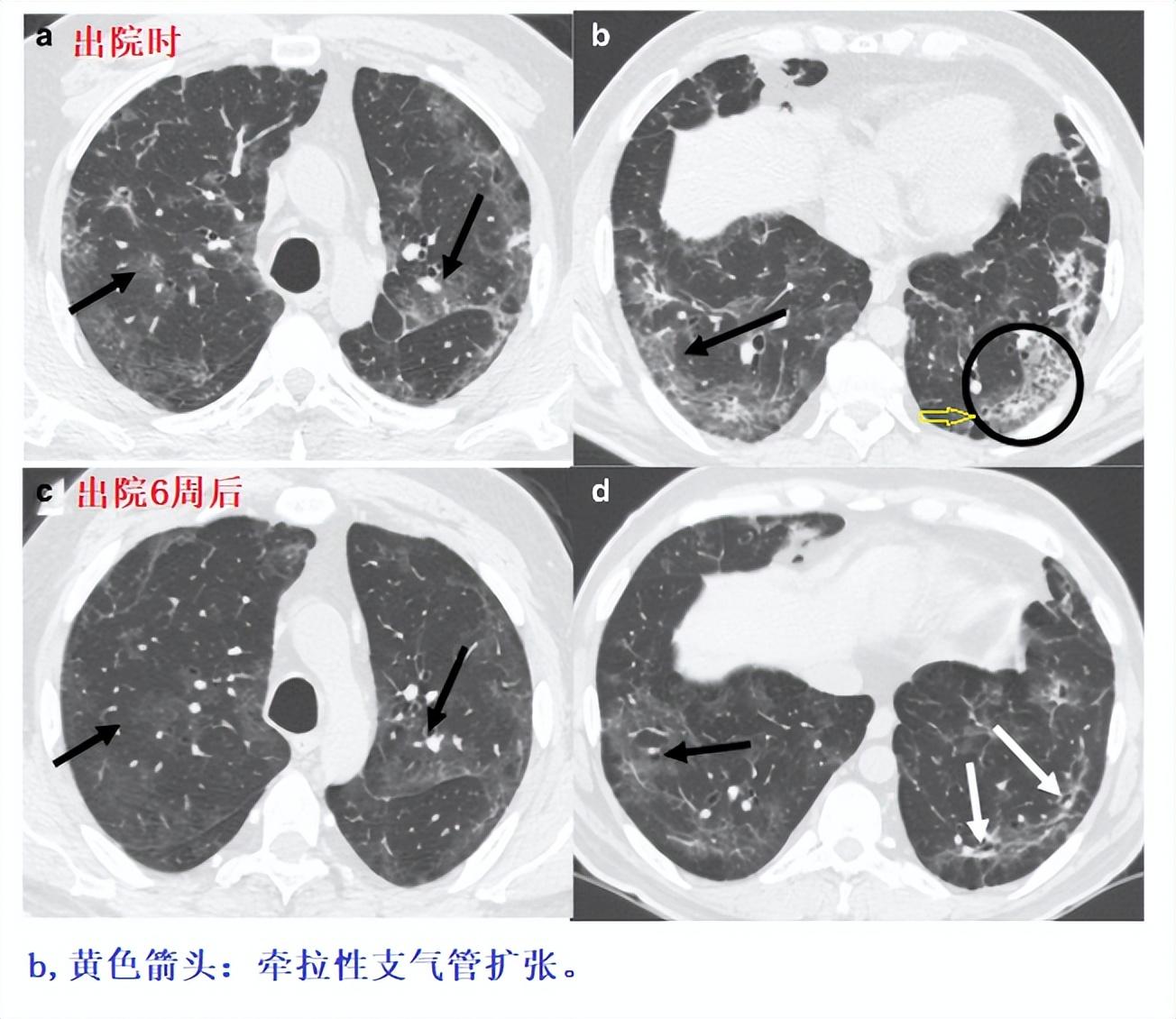 全球新冠肺炎最新动态及应对策略，疫情进展与防控措施更新